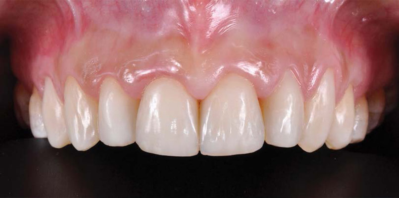 Direct Anterior Restorations After