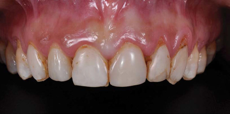 Direct Anterior Restorations Before