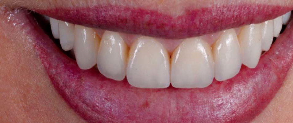 Indirect Anterior Restorations After