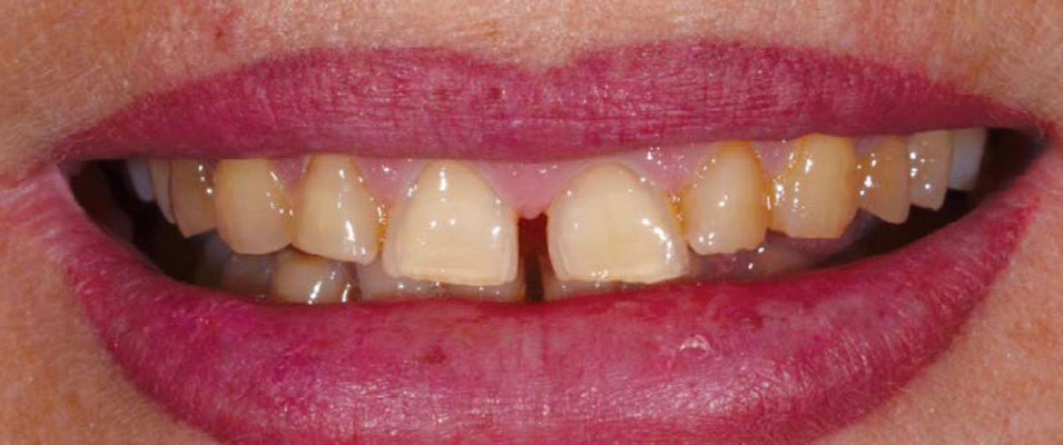 Indirect Anterior Restorations Before